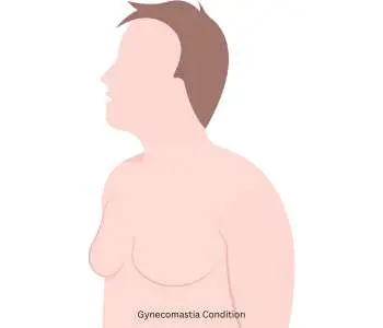 What is Gynecomastia?