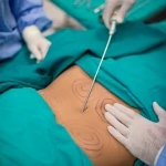 Liposuction surgery at Vanya Clinic, Delhi