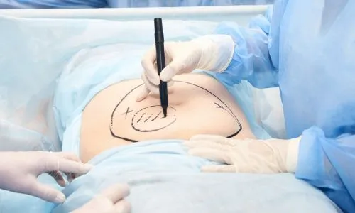 Stomach liposuction in Delhi