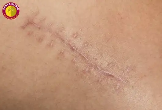 What is a Scar