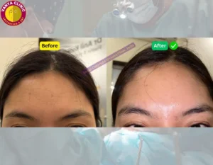 Botox for Forehead Wrinkles in Delhi - Before and After Photos