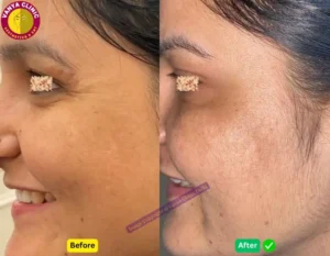 Crows Feet Botox Before and After in Delhi near Green Park