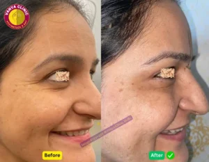 Crows Feet Botox Before and After in Delhi - Right View - near Green Park