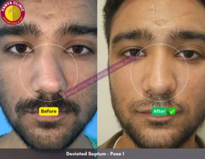 Deviated Septum - Before After Image - Pose 1 - Front Angle