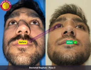 Deviated Septum - Before After Image - Pose 2 - Front Angle