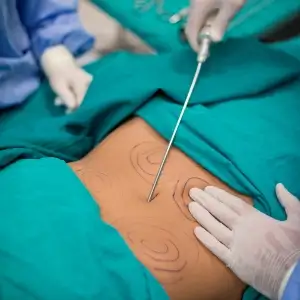 Liposuction in Delhi