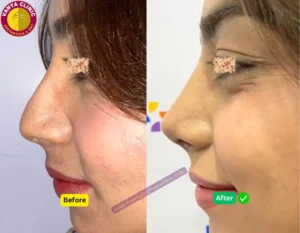 Rhinoplasty Before After Photo Female in India - Wide Nose Surgery - Pose 1 - Left Angle