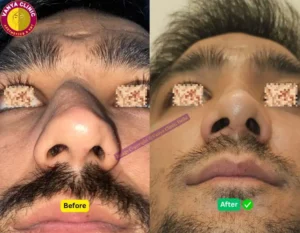 Rhinoplasty Before After Photo Male in Delhi - Deviated Septum - Pose 2 - Front Angle