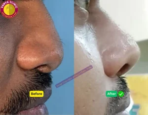 Rhinoplasty Before After Pictures in Delhi- Wide Nose Surgery - Pose 2 - Right Side Angle