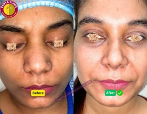 Wide Nose Rhinoplasty Female Before and After Photo Delhi