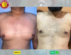 Grade 2 Gynecomastia Before and After Photo in Delhi - Front View