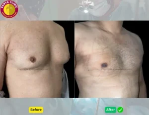 Grade 2 Male Breast Surgery by Best Gynecomastia Surgeon in Delhi - Side View