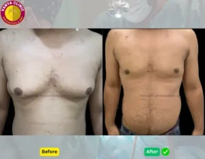 Grade 3 Gynecomastia Before and After in Delhi India