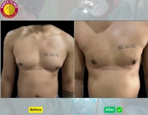 Gynecomastia Before and After in Delhi