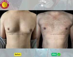 Gynecomastia Before and After in Delhi - At Vanya Clinic, Green Park, New Delhi