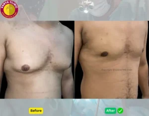 Gynecomastia Before and After in Delhi - Front view in Delhi