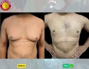 Gynecomastia Before and After in Delhi India at Vanya Clinic