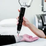 Laser tattoo removal in Delhi