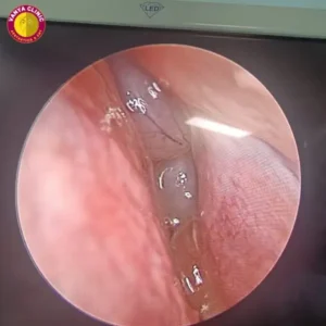 Nasal Polyps Present before operation