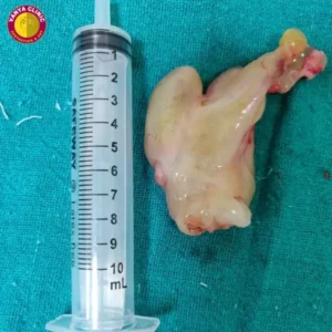 Removed Nasal Polyps - Polyps Surgery by Dr. Purodha Prasad