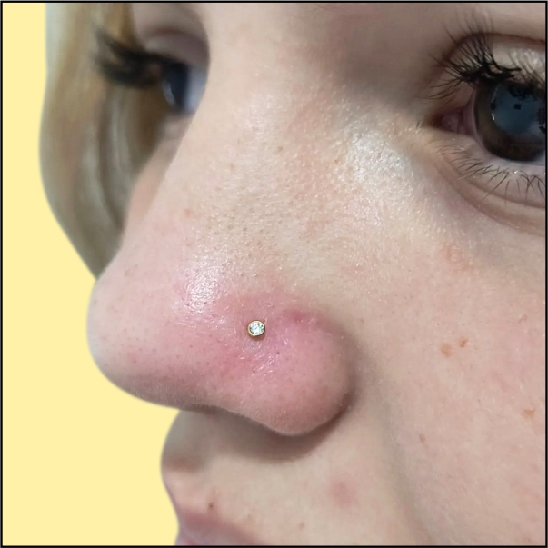 Nose Piercing in Delhi 8 Vanya Clinic 8 Nose Piercing