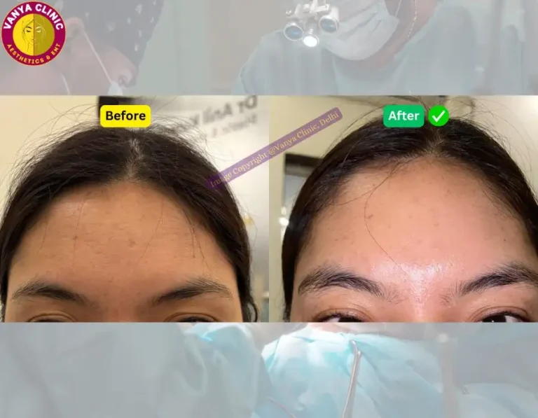 Botox Before After 1 768x597 1