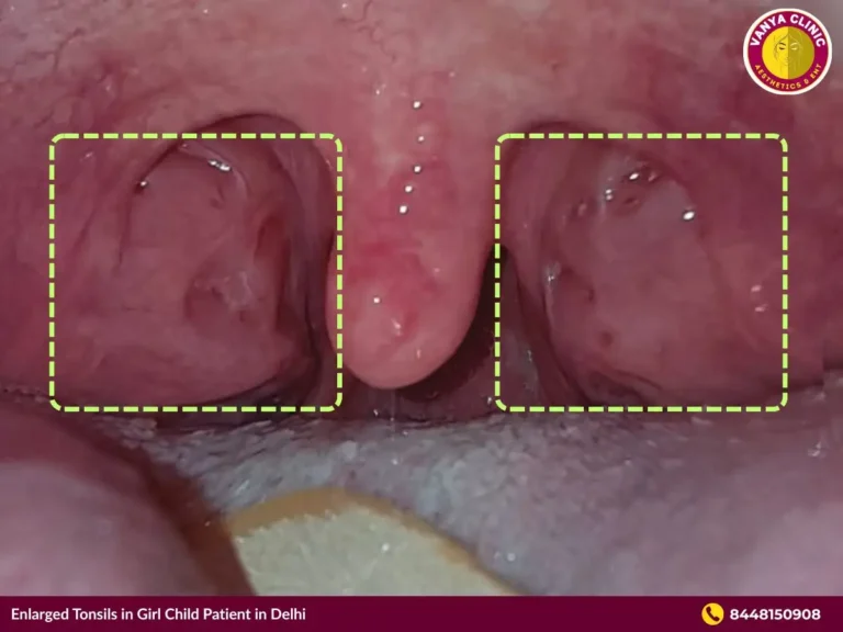 Pediatric ENT Specialist in Delhi for Infant, Kids, Children 1 Enlarged tonsils highlighted in girl child.