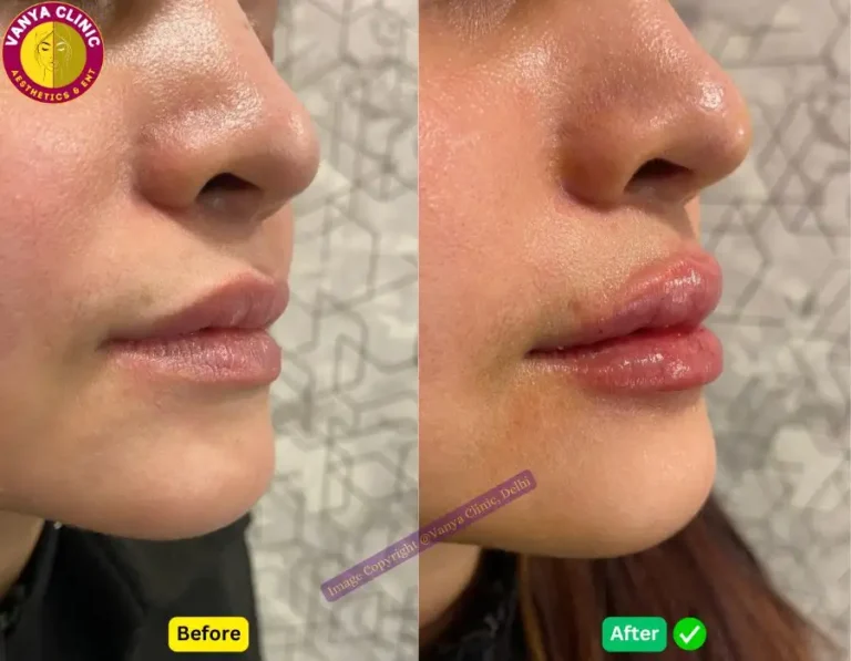 Lip Fillers Before and After Photos in Delhi 768x597 1