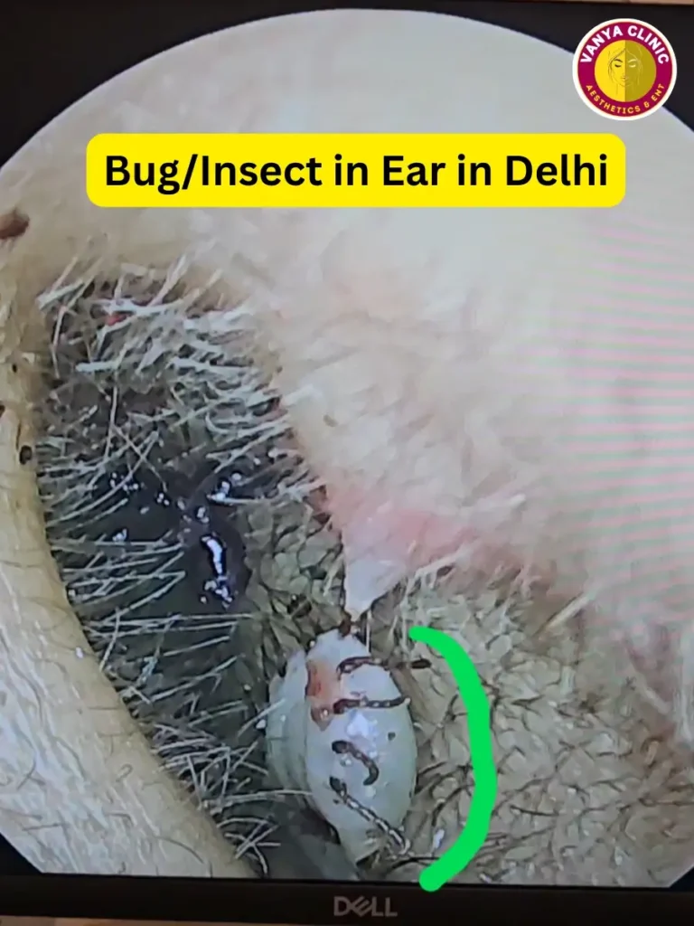 Foreign Body Removal in Delhi - Ear, Nose, Throat, Esophagus 4 A dead bug inside the ear in Delhi patient.