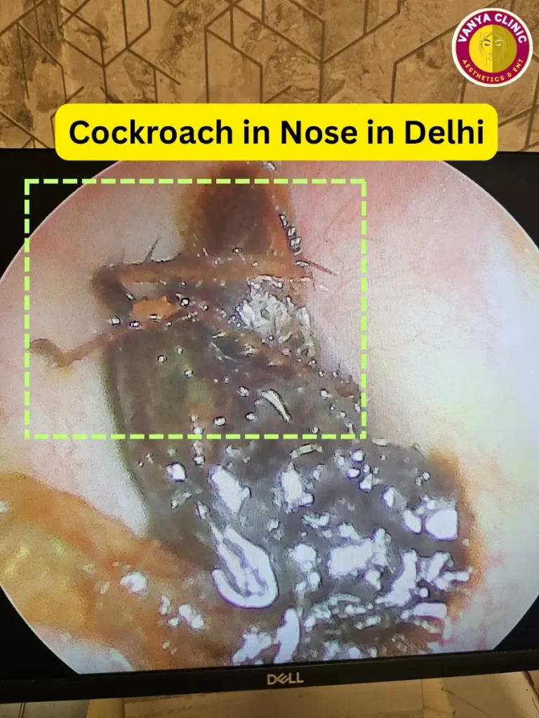 Foreign Body Removal in Delhi - Ear, Nose, Throat, Esophagus 3 A dead cockroach inside nose in Delhi patient.
