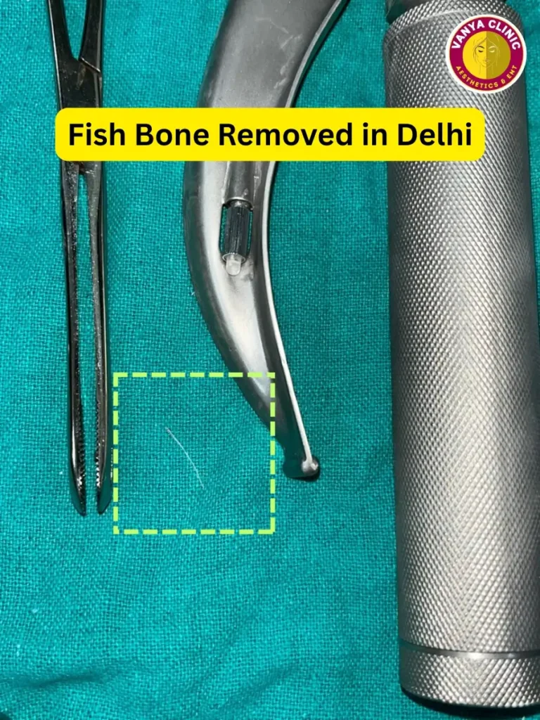 Foreign Body Removal in Delhi - Ear, Nose, Throat, Esophagus 2 A tiny fish bone after removal from throat in Delhi patient.