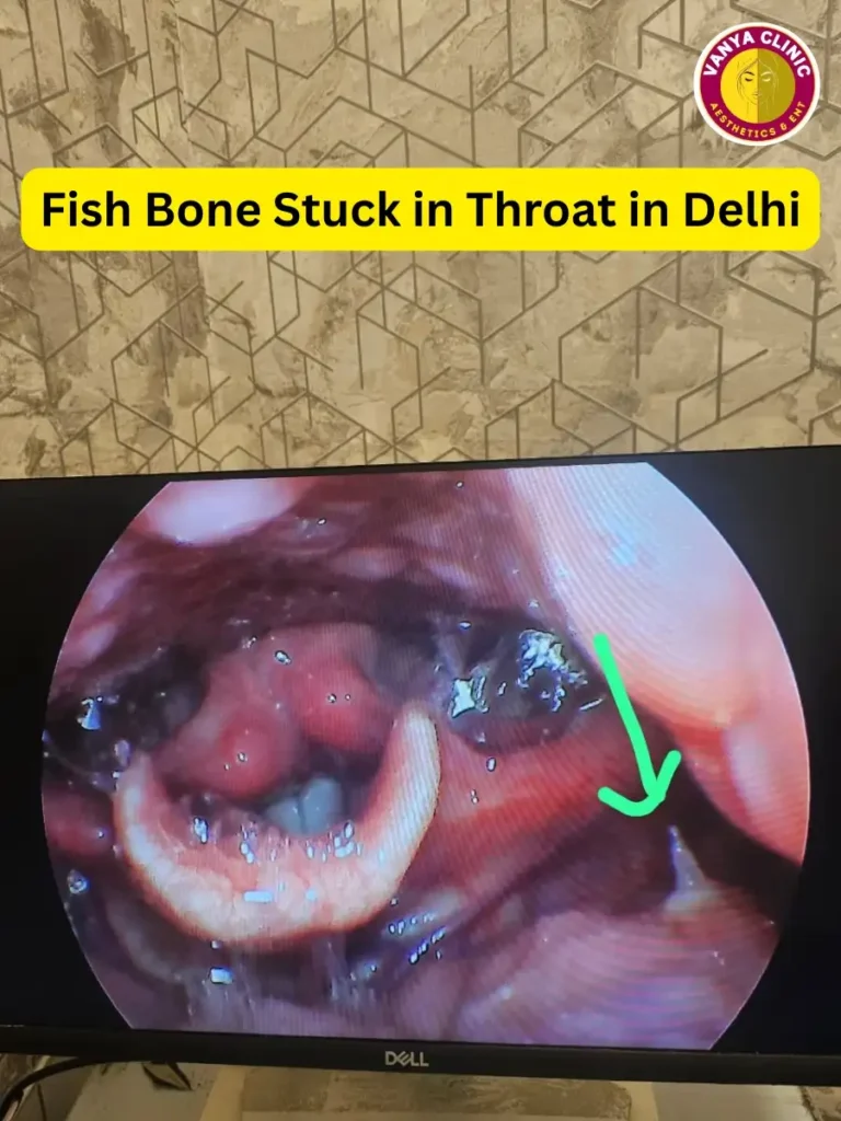 Foreign Body Removal in Delhi - Ear, Nose, Throat, Esophagus 1 Fish Bone Stuck in Throat in Delhi visible on endoscope monitor