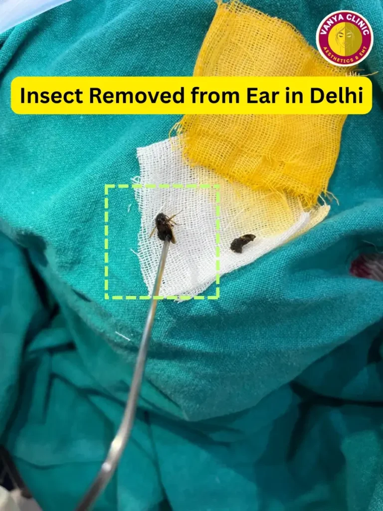 Foreign Body Removal in Delhi - Ear, Nose, Throat, Esophagus 6 Insect held in surgical fork after removal from Ear.