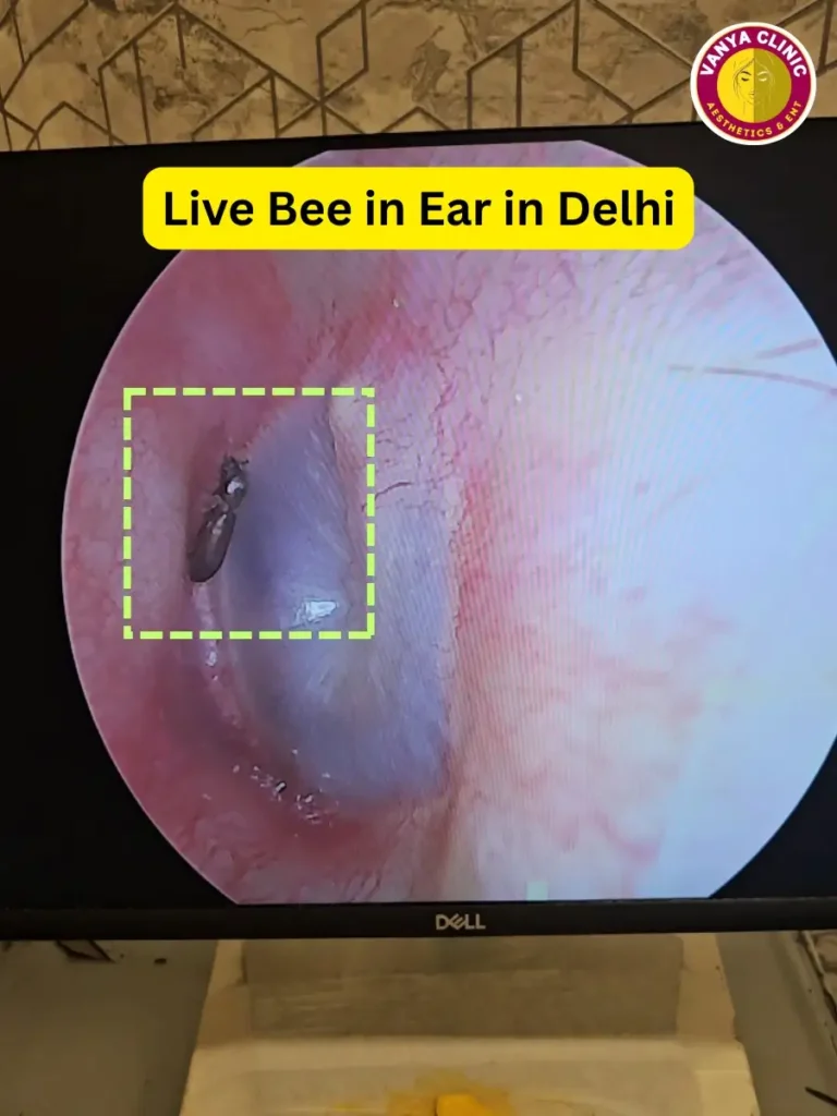 Foreign Body Removal in Delhi - Ear, Nose, Throat, Esophagus 5 A live bee walking inside ear in Delhi patient.