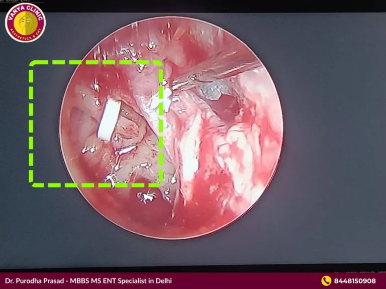 Stapedotomy Otosclerosis Surgery in Delhi - Get 10% Off Cost 2 Photo of Middle Ear After Stapedotomy surgery in Delhi by Dr. Purodha Prasad