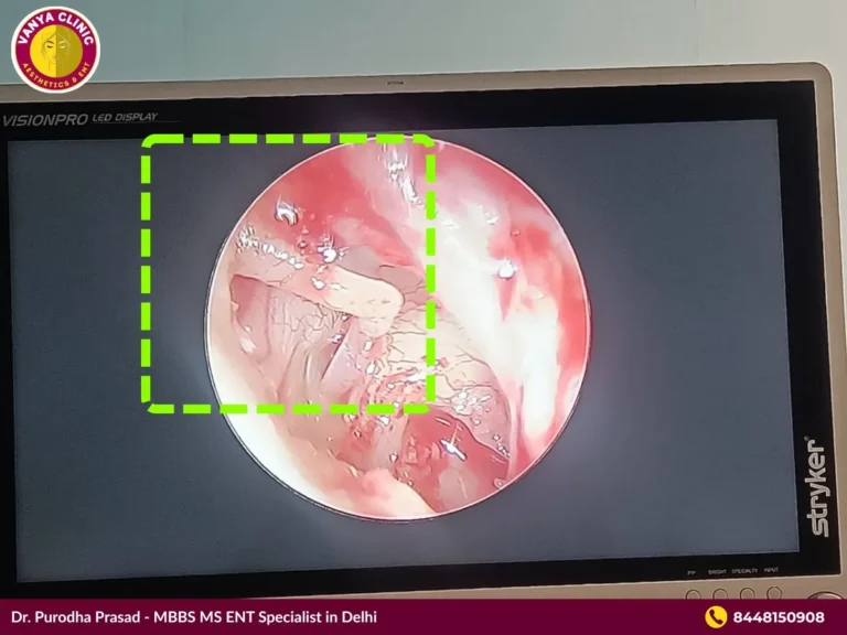Stapedotomy Otosclerosis Surgery in Delhi - Get 10% Off Cost 1 Photo of Middle Ear before Stapedotomy surgery in Delhi by Dr. Purodha Prasad