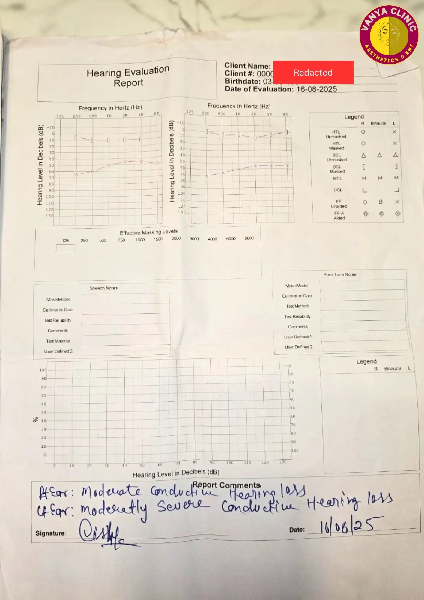 Stapedotomy Otosclerosis Surgery in Delhi - Get 10% Off Cost 6 Pure Tone Audiometry for Conductive Hearing Loss in Delhi for Female patient - 16-8-2025
