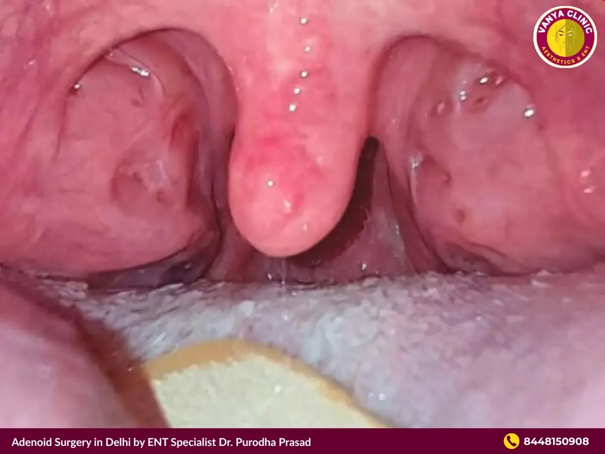 Swollen adenoid in child patient in Delhi.