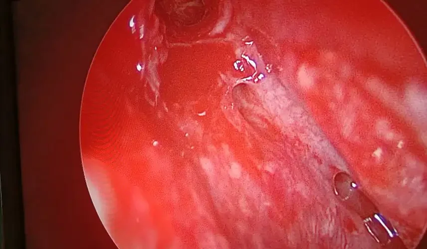 Frontal Sinus Opening After Balloon Sinuplasty in Delhi