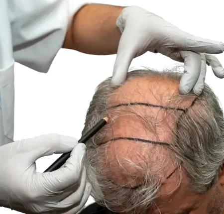 Hair Transplant surgery in Delhi