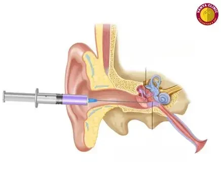 Intratympanic injection for hearing loss treatment in delhi Dr. Purodha Prasad Intratympanic injection for hearing loss treatment in delhi Dr. Purodha Prasad