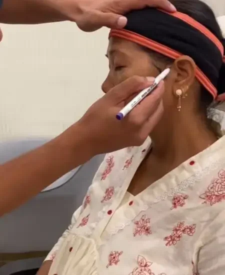 Juvederm Botox Treatment at Botox Event on 4 Aug