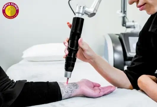 Laser tattoo removal in Delhi