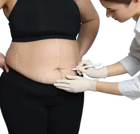 Liposuction surgery in Delhi