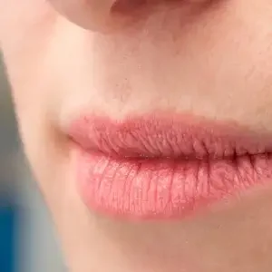 Lipstick Lines Botox Treatment in South Delhi