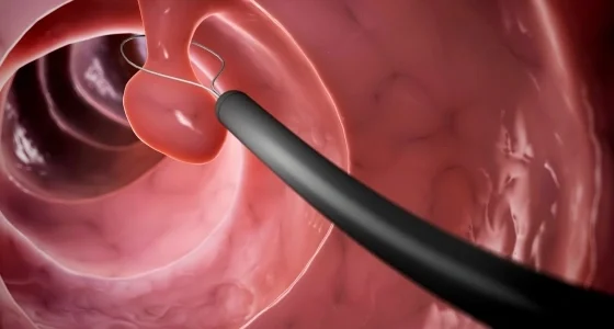 Nasal Polyps Surgery in Delhi by Dr. Purodha Prasad