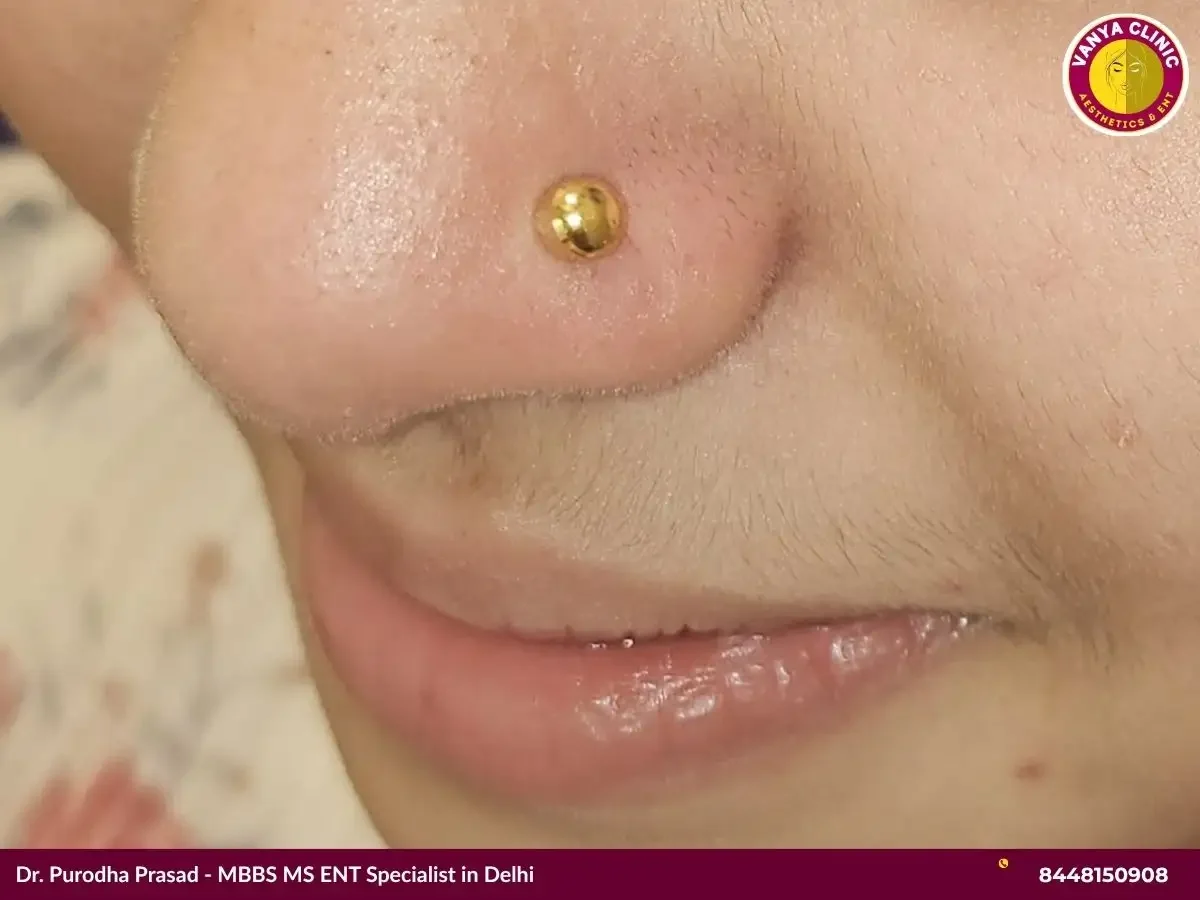 Actual nose piercing done by Dr. Purodha Prasad in Delhi.