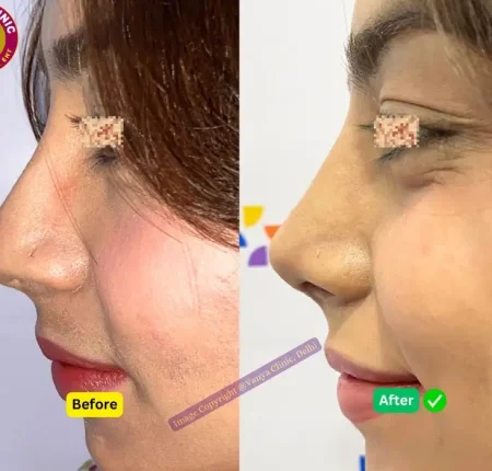 Rhinoplasty Before After Photo Female in India - Wide Nose Surgery - Pose 1 - Left Angle