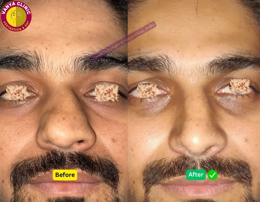 Rhinoplasty Before After Photo in Delhi - Saddle Nose Repair - Pose 1 - Front Angle