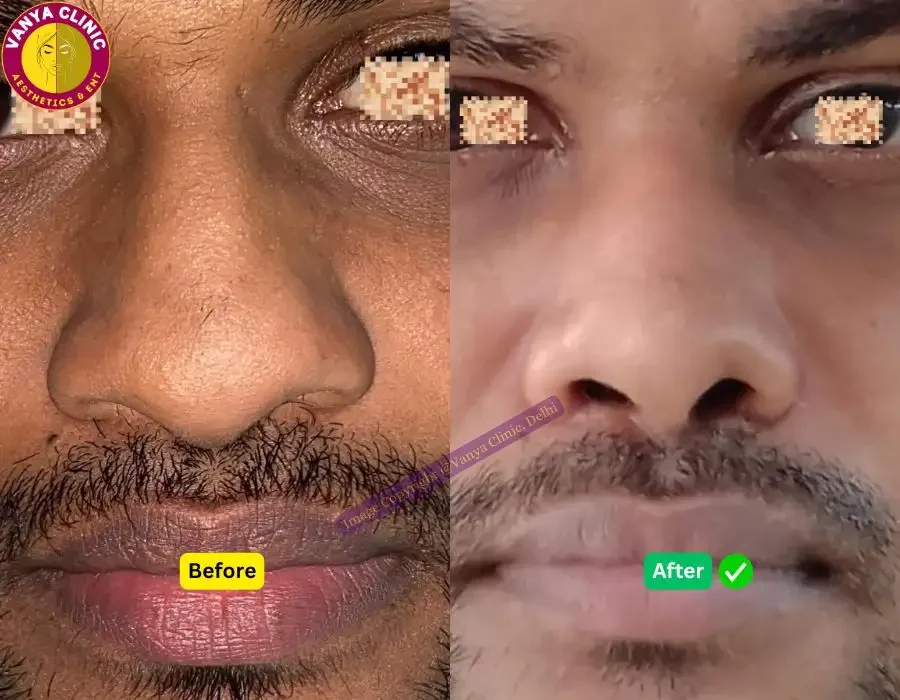 Rhinoplasty Before After Pictures in Delhi - Wide Nose Surgery - Pose 3 - Front Angle